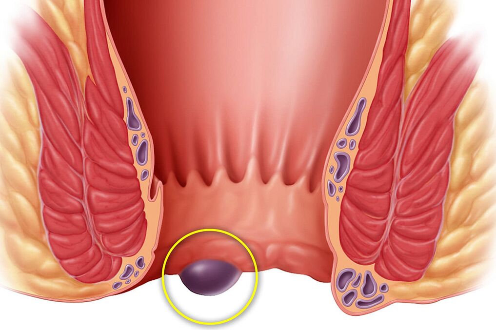 tumors